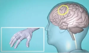 rTMS در توانبخشی نورولوژیک